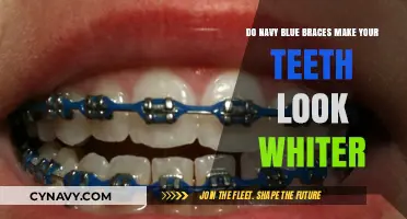 Smile Makeover: How Navy Blue Braces Enhance Teeth Whiteness