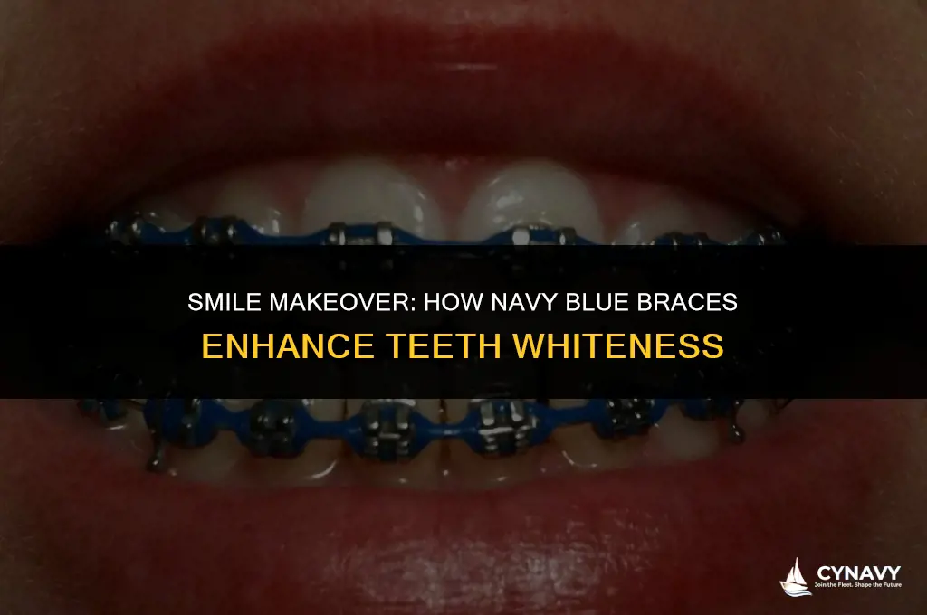 do navy blue braces make your teeth look whiter