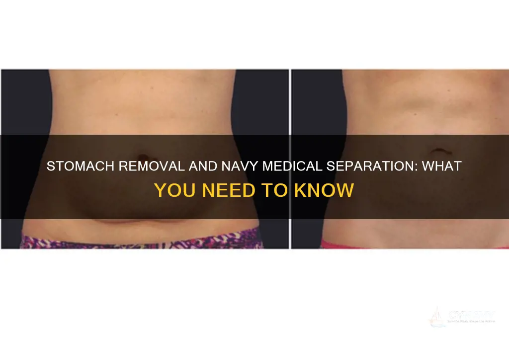 does getting stomach removed medically separated from the navy